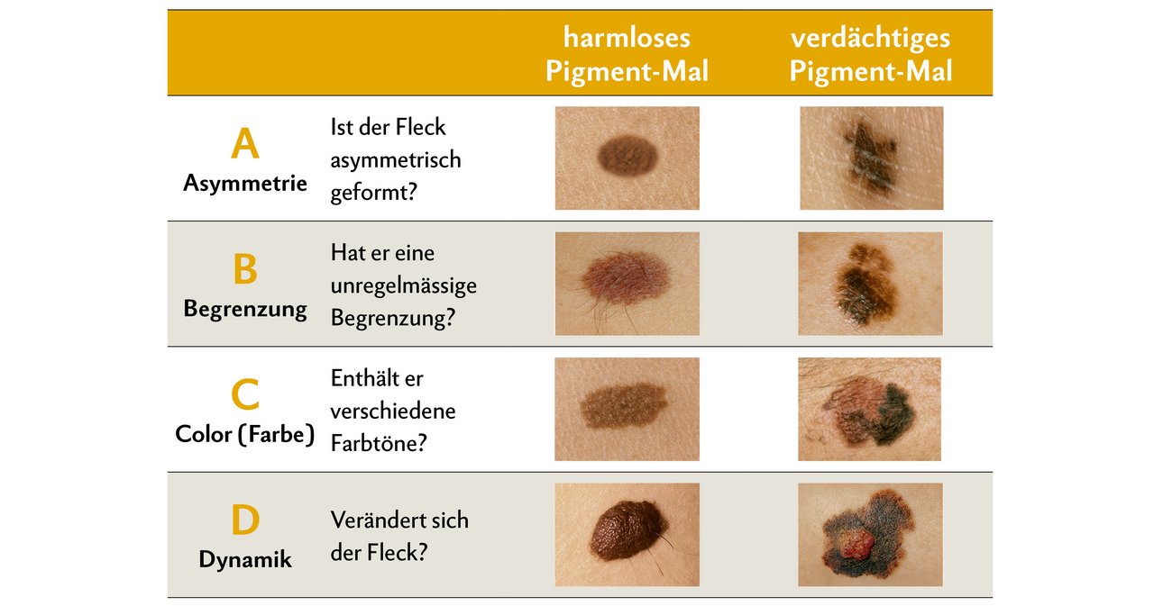 Wie erkennt man ein Melanom? Pigment-Male, die sich verändern, können gefährlich sein. Deshalb sollten sie so rasch als möglich von einem Dermatologen untersucht werden.  Quelle: Dermatologie et vénéréologie, Hôpitaux Universitaires de Genève